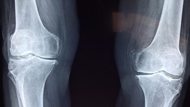 kitajski znanstveniki razvili kostno lepilo ki v 3 minutah zdravi zlome 68dd420632616 1759330822